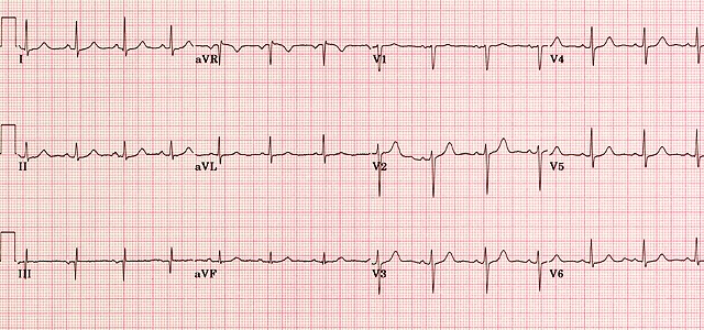 What Are The Normal Values Of Ecg